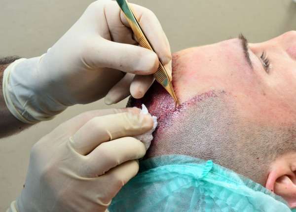 Transplantasi Rambut Adalah
